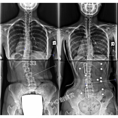 案例11：穿背架X光對比.jpg