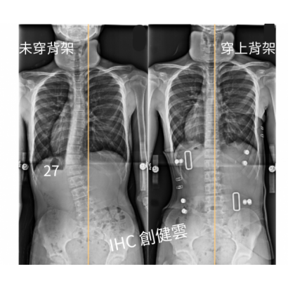 35.X光對比 14歲男生.png