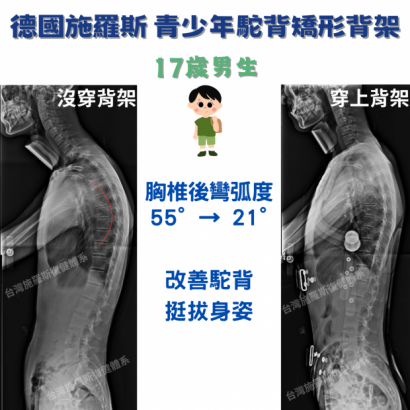 X光對比 駝背背架 7128.png